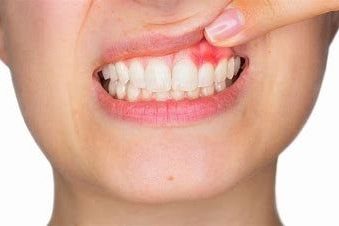 kinderwunsch zahnfleischentzündung paredontose