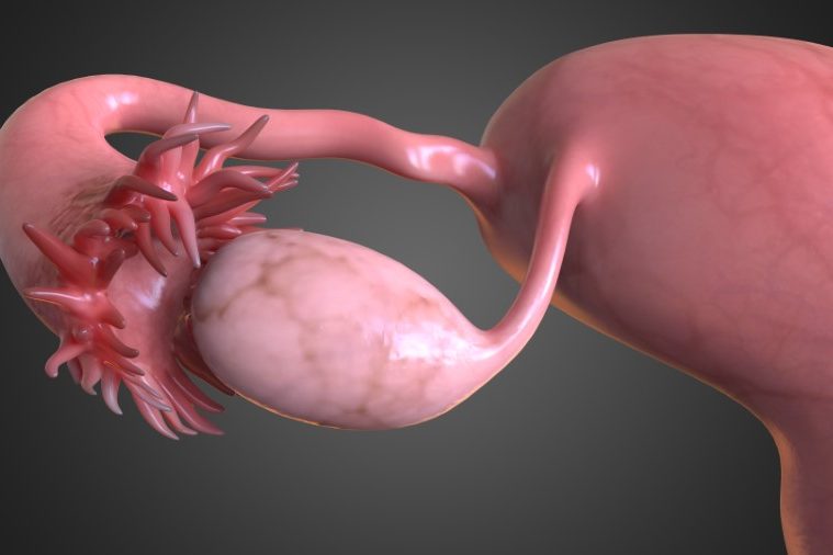 pco polyzystische ovarien was hilft