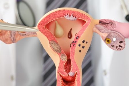 endometriose kinderwunsch