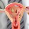 endometriose kinderwunsch