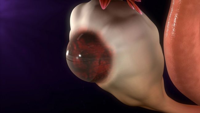 zyste myom unterschied