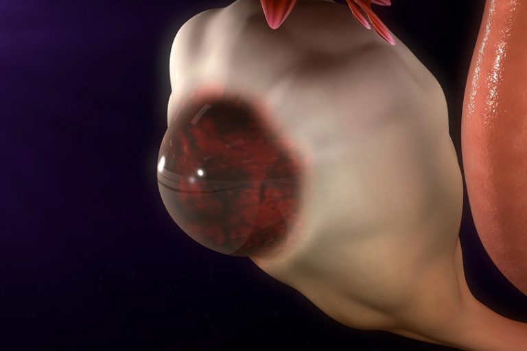 zyste myom unterschied